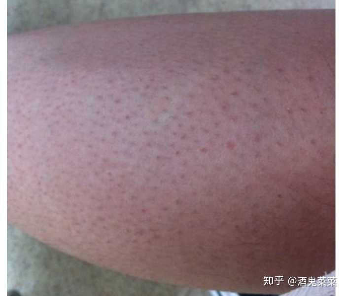 皮肤角化症鸡皮肤(鸡皮角质化皮肤病什么样)