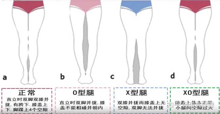 Xo型腿如何靠按摩或锻炼矫正 知乎