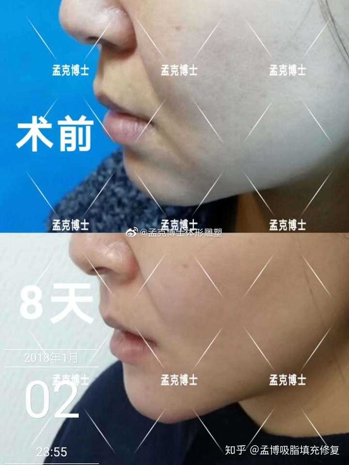 随着年龄增长,人面下巴俩侧会出现凹坑样的改变!