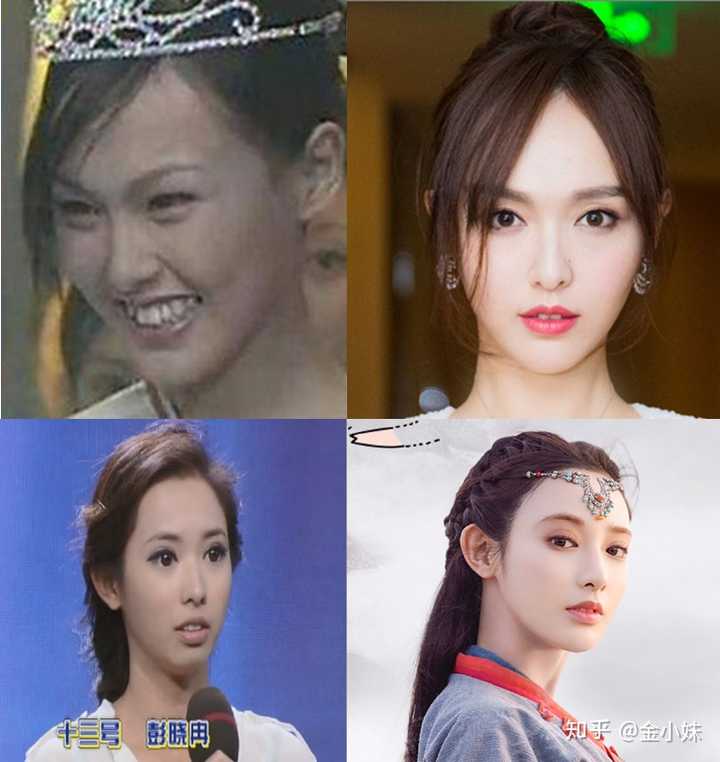 明星都是在什么时候戴牙套?