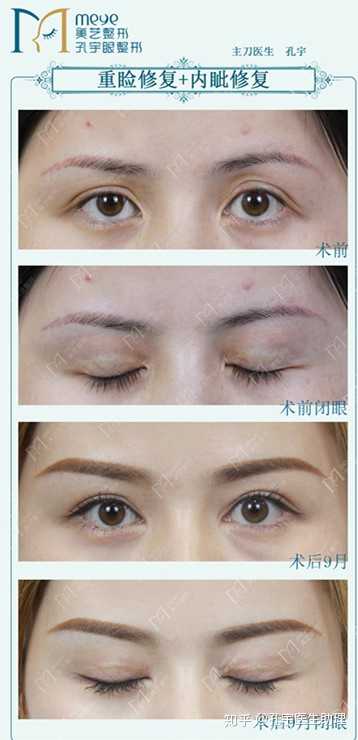 听说做了双眼皮手术 老了之后眼睛会很难看 是真的吗 知乎