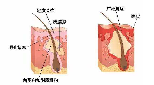 ▍皮膚受損容易有炎症