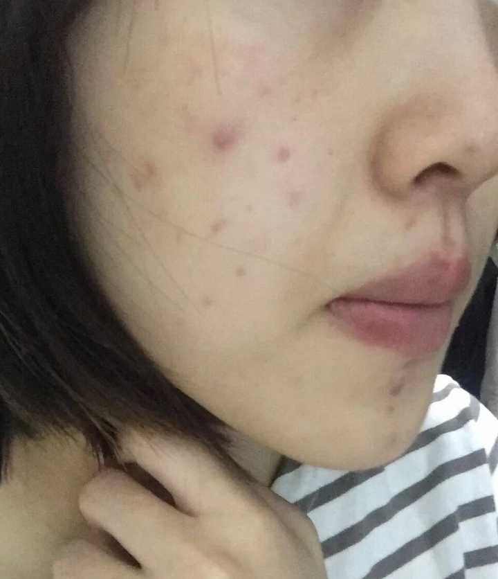 脸上一直长粉刺怎么办 知乎