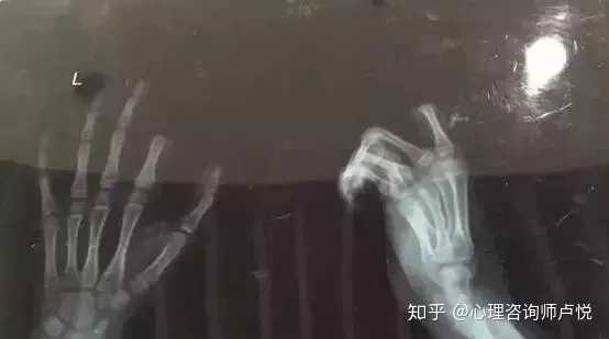 为什么会有人想自杀呢?