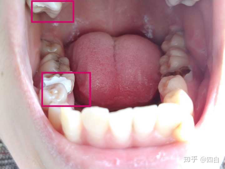 根管治疗疼不疼 知乎