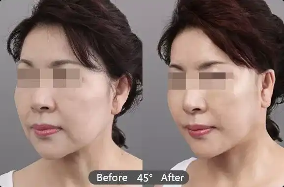 玻尿酸怎样用效果最好?