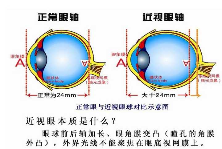 长时间戴眼镜,引起眼睛的变形,这该怎么矫正?