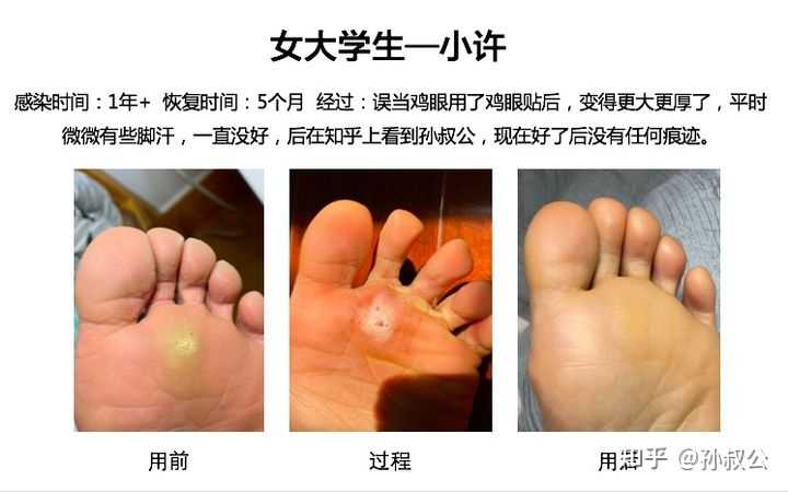 跖疣和鸡眼有什么区别 医学上有没有什么治疗跖疣的好办法 知乎 跖疣和鸡眼有什么区别 医学上有没有什么治疗跖疣的好办法 知乎