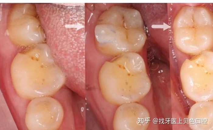 牙合 面用樹脂斜面導板(有導板成型模具製作方便),一提供牽引時路徑