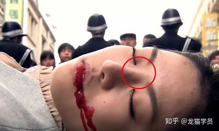 山根明显变高,但鼻头形状和圆钝感没怎么变,猜测是做了玻尿酸隆山根