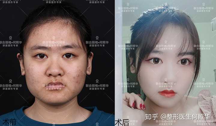 对于女生来说 脸型和五官哪个更重要 有哪些改善脸型的方法 是否能通过做瘦脸操改变脸型呢 知乎