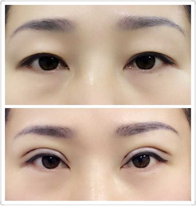 沈阳孟强做的双眼皮手术当时效果好吗?