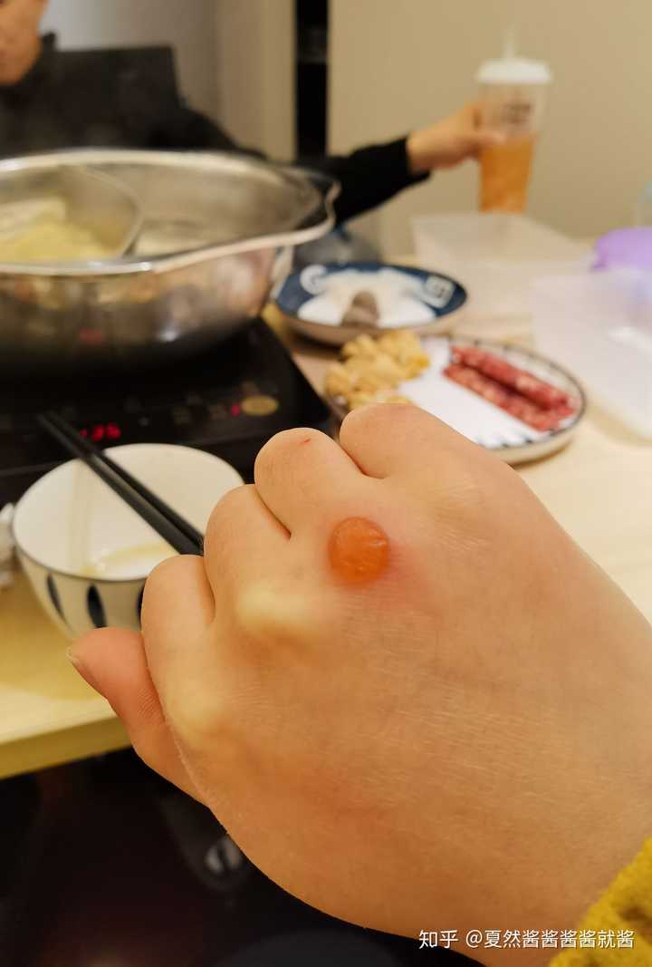 烫伤后起的水泡什么时候消下去 知乎 烫伤后起的水泡什么时候消下去 知乎