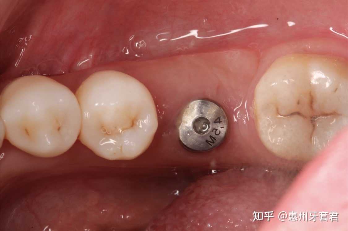 惠州牙套君 的想法: 关于种植牙护理大合集 1,种植牙术后,一… 
