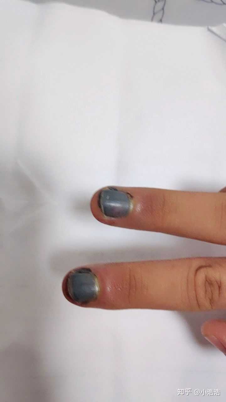 手指甲盖发紫图片