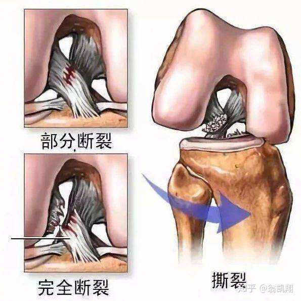 每天跑步容易伤膝盖 那部队里面军人每天锻炼 他们的膝盖都会有问题吗 知乎