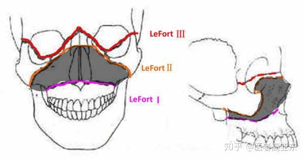 是相当于以鼻前嵴为中心,两侧的骨块前移,实际效果就是「上颌骨lefort