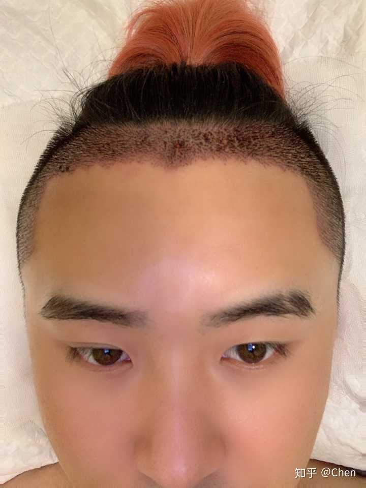 植发大概需要多少钱 知乎 植发大概需要多少钱 知乎