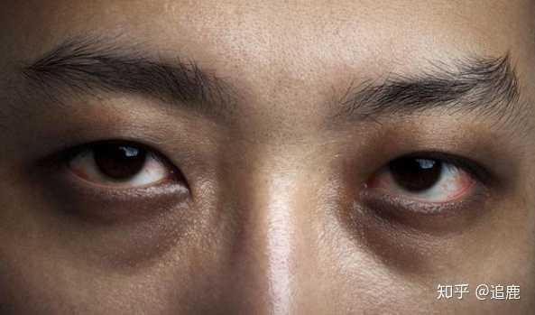 怎么判断黑眼圈的种类怎么消除