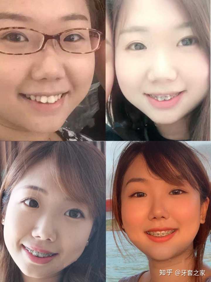 [矫正原因] 初中就想整牙,爹妈不同意说牙齿会松的以后.