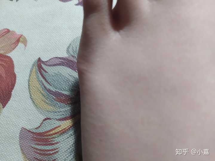 小脚趾骨刺图片