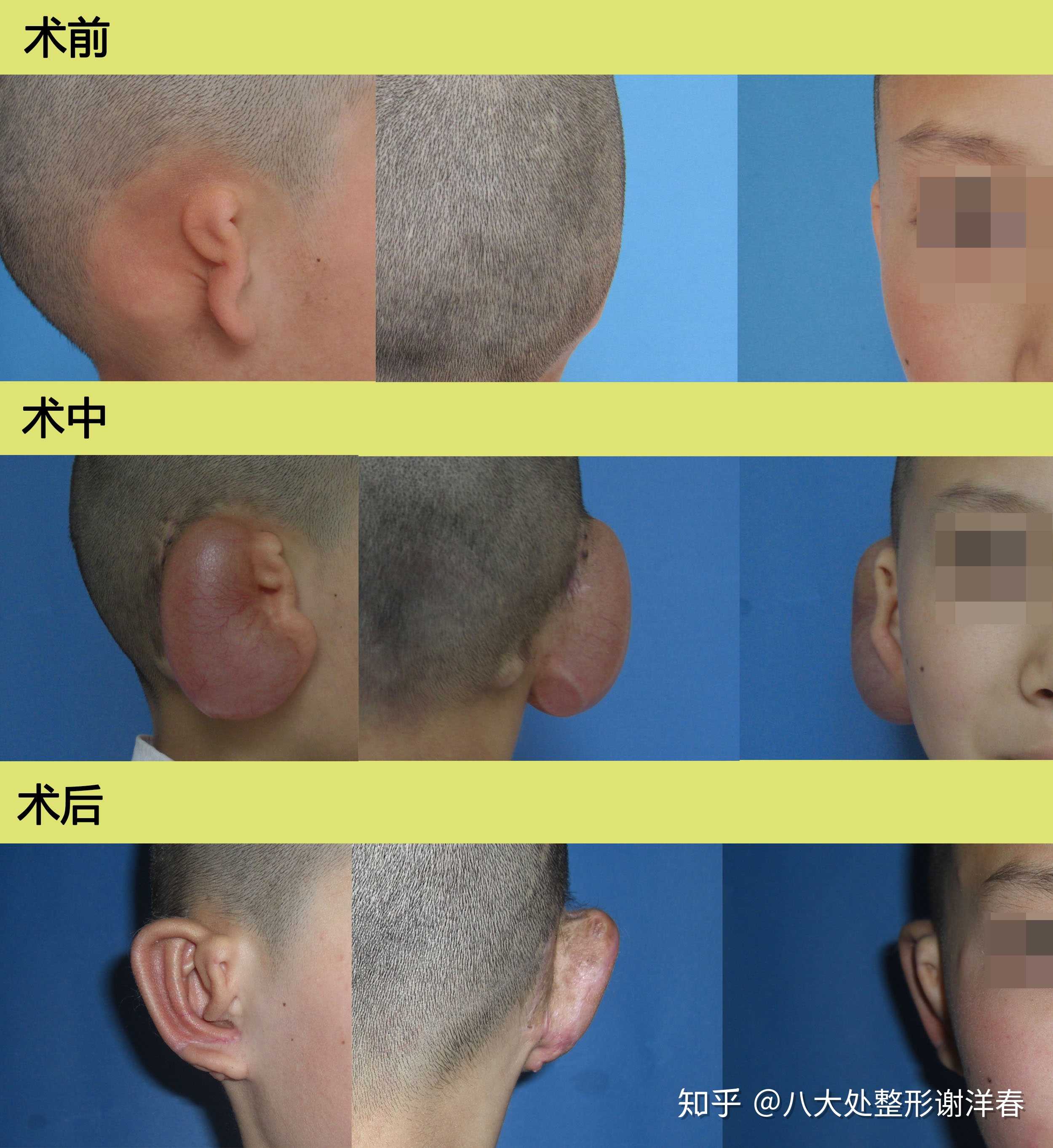 【案例】右耳先天性畸形,術前 術中 術後… - 知乎