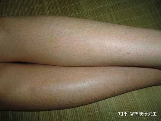 小腿皮肤很干燥 像鱼鳞一样怎么消除 知乎 小腿皮肤很干燥 像鱼鳞一样怎么消除 知乎
