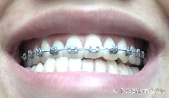 现在武大口腔医院成人正畸大概费用是多少 知乎