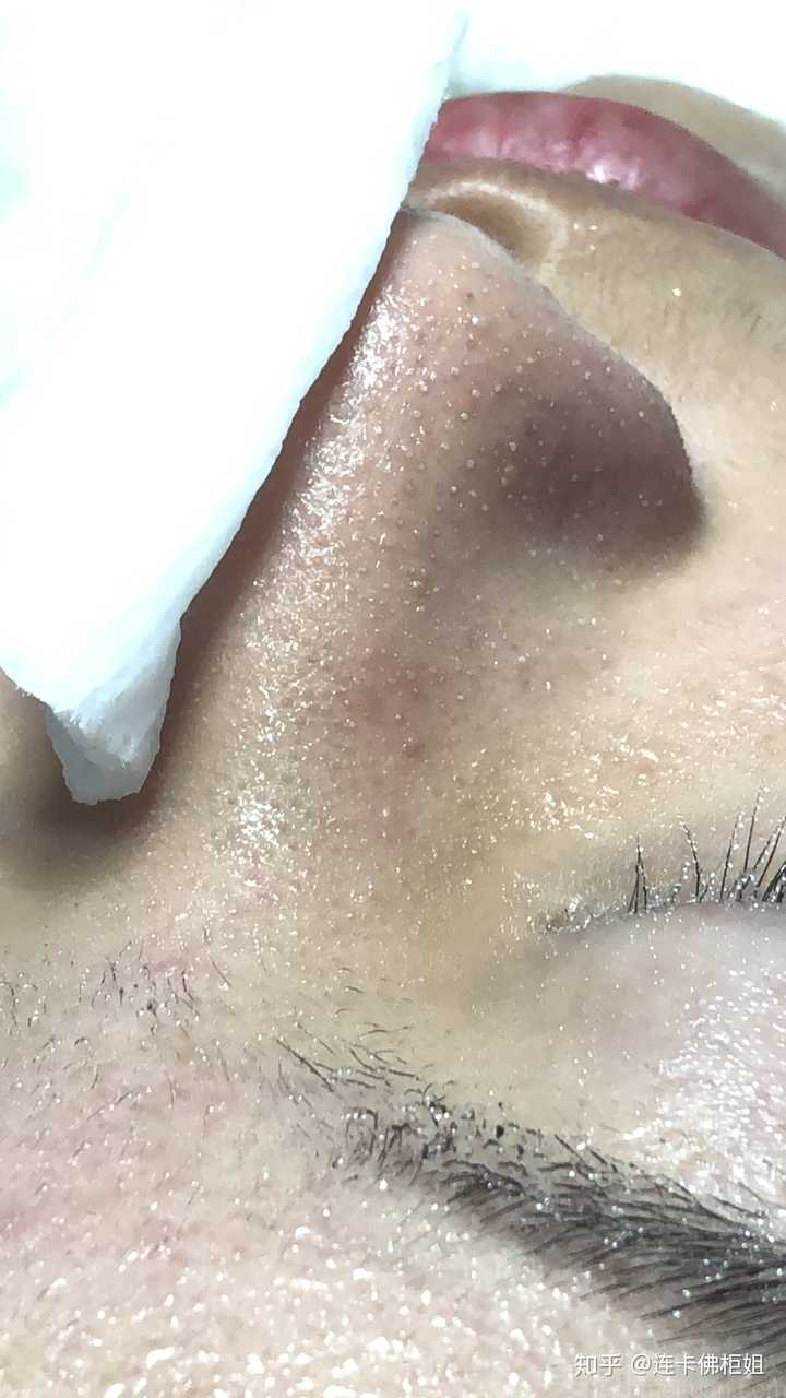 问问各位乎友,有什么好的方法或者产品去黑头和粉刺吗?