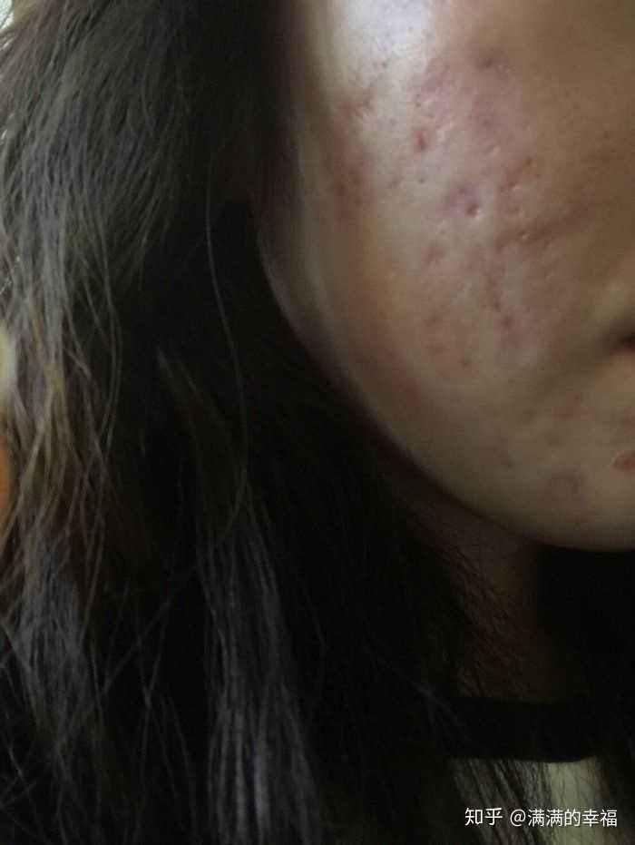 怎样去痘痘?消痘印?