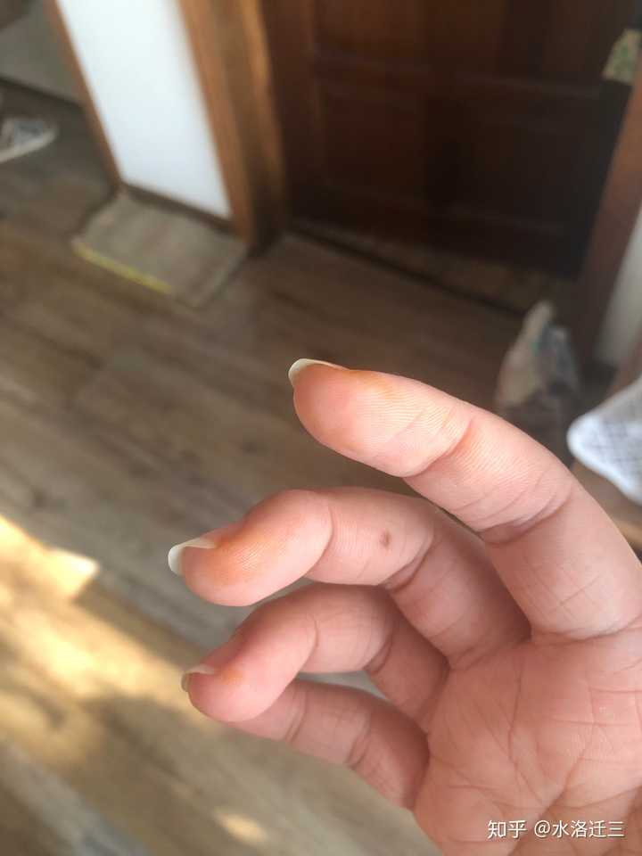一觉醒来手上有铁锈一般的黄色块洗不掉?