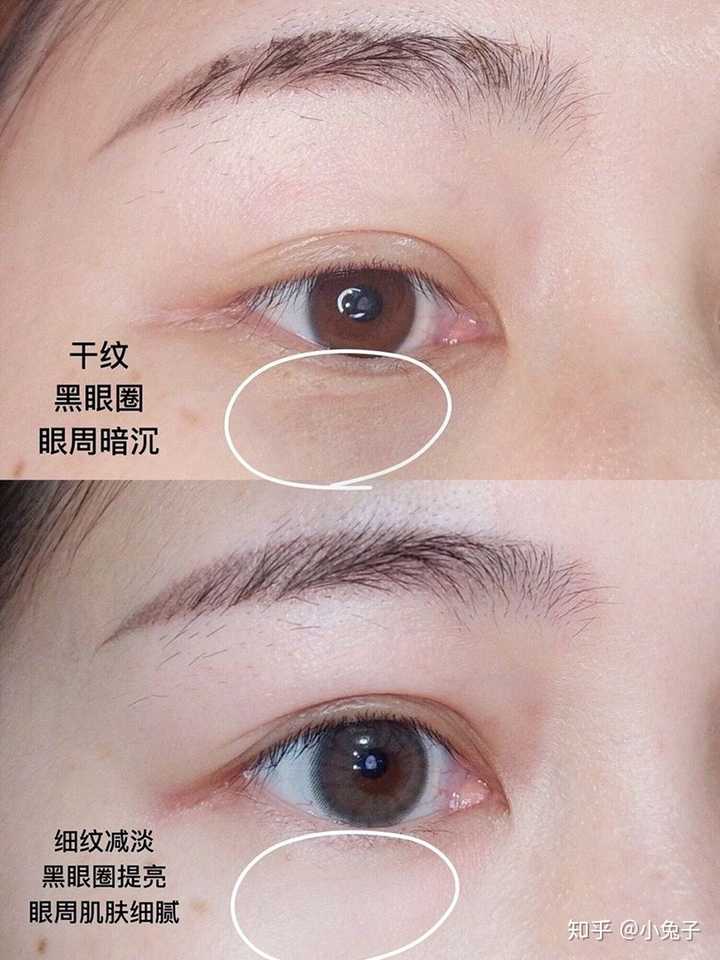 如何分辨并去除眼袋和黑眼圈 知乎 如何分辨并去除眼袋和黑眼圈 知乎