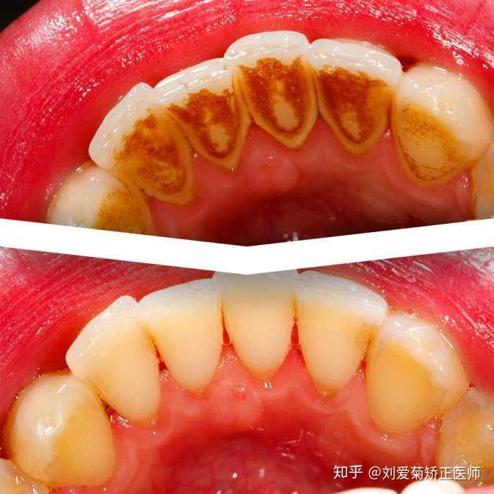 有洗过牙的朋友吗 洗牙好吗 知乎