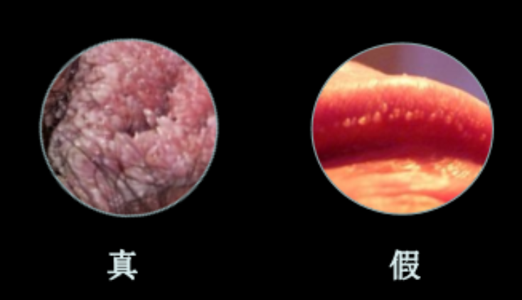 什么是假性湿疣假性湿疣的诱发因素有哪些