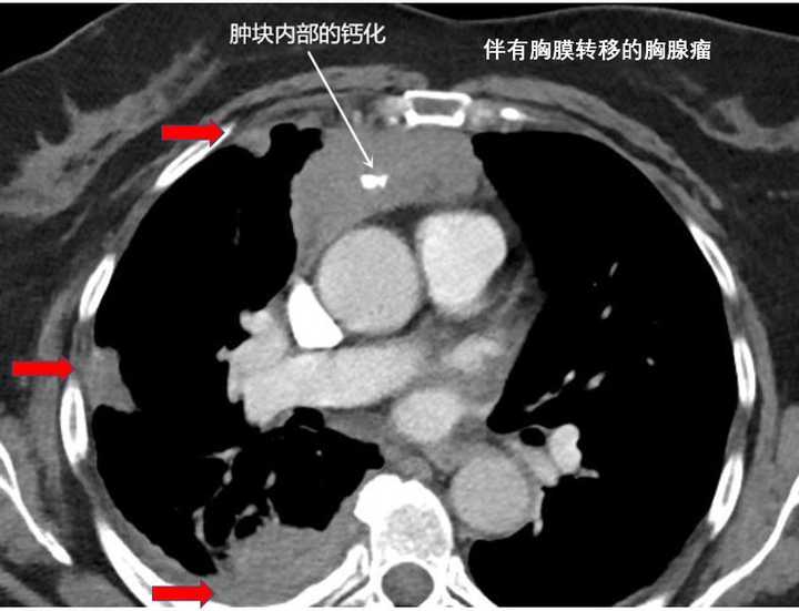 增强ct是否能判断胸腺瘤是良性还是恶性的 谢冬的回答 知乎