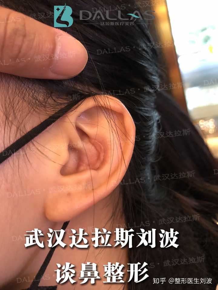 耳朵取软骨后愈合照片图片