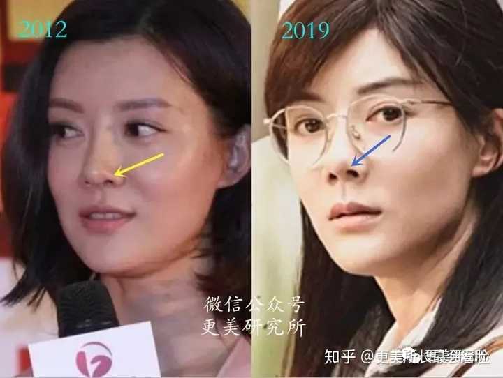 鼻孔外露的塌鼻子 大臉妹子如何逆襲(附照片)?