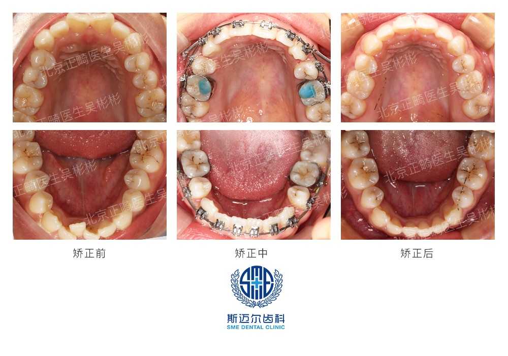 拔牙矫治4颗4号牙,支抗钉进行内收,侧貌改善明显