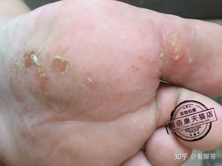 你是怎么治好脚气的?