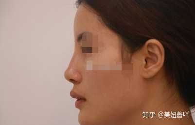 做鼻综合是什么体验 知乎