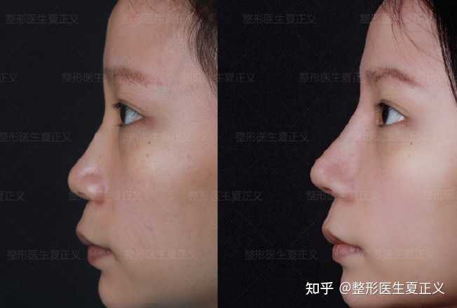 14【全肋软骨鼻综合 宽鼻矫正61术后4个月反馈】小姑娘是初鼻求美者