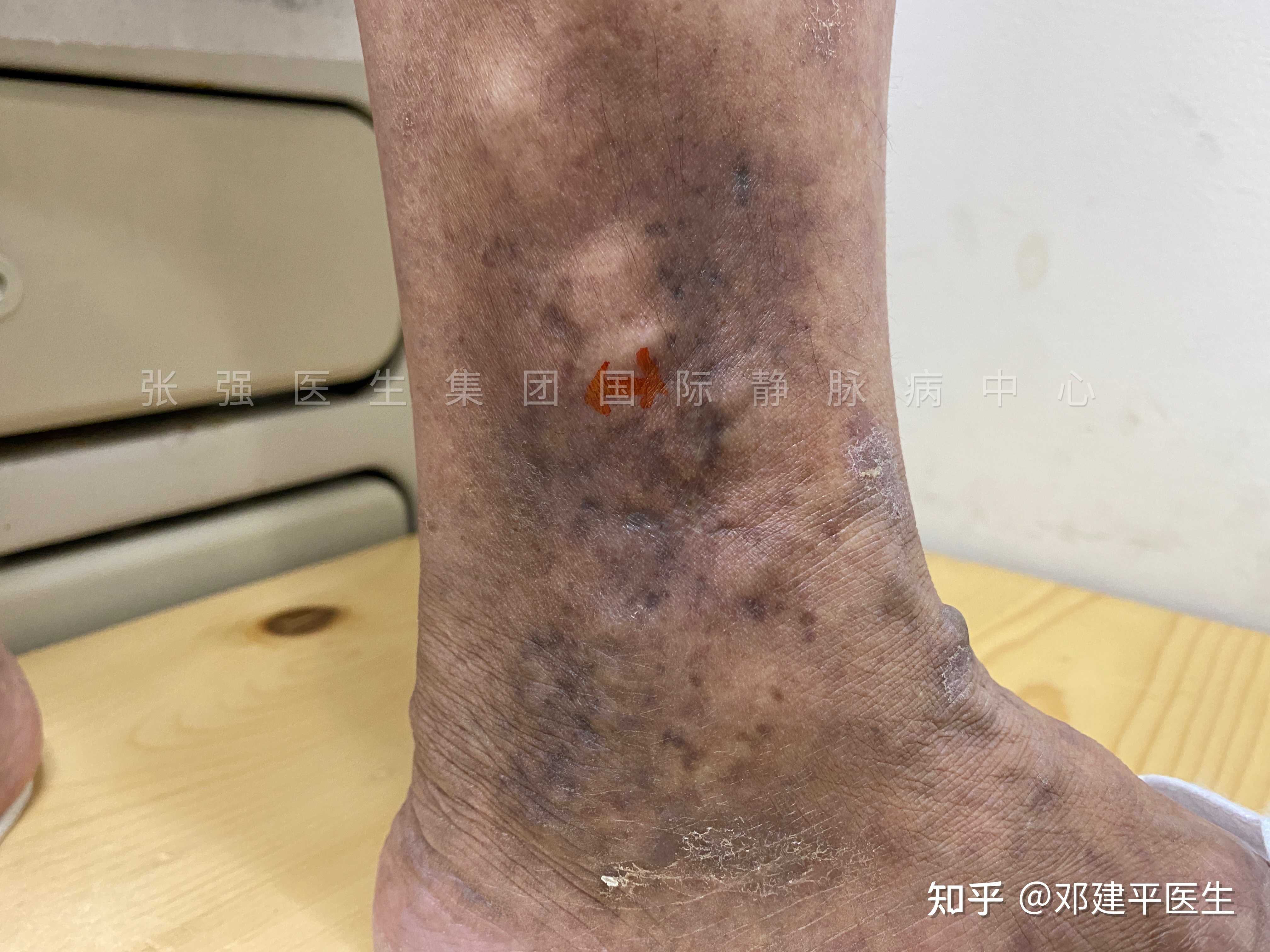 下肢静脉曲张第4期有明显的足踝区色素沉着水肿皮炎如果不及时采取