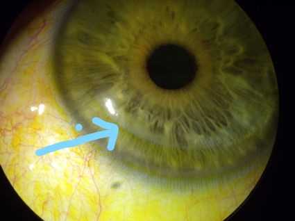 ingrowth / haze) 病因:手术过程中上皮细胞落到了角膜瓣之下,然后