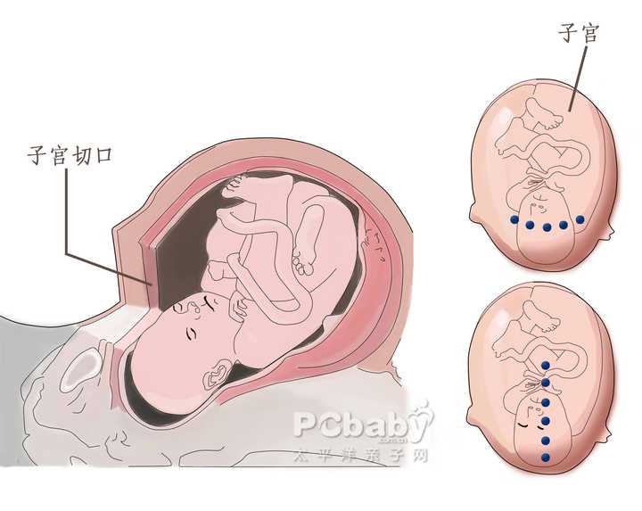 小儿隐睾手术过程图解图片