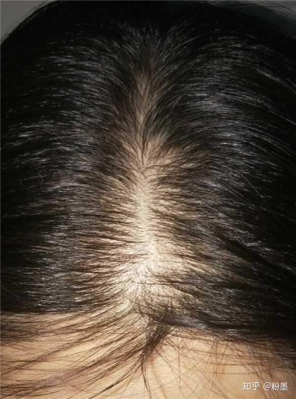 女性头顶头发稀少图片