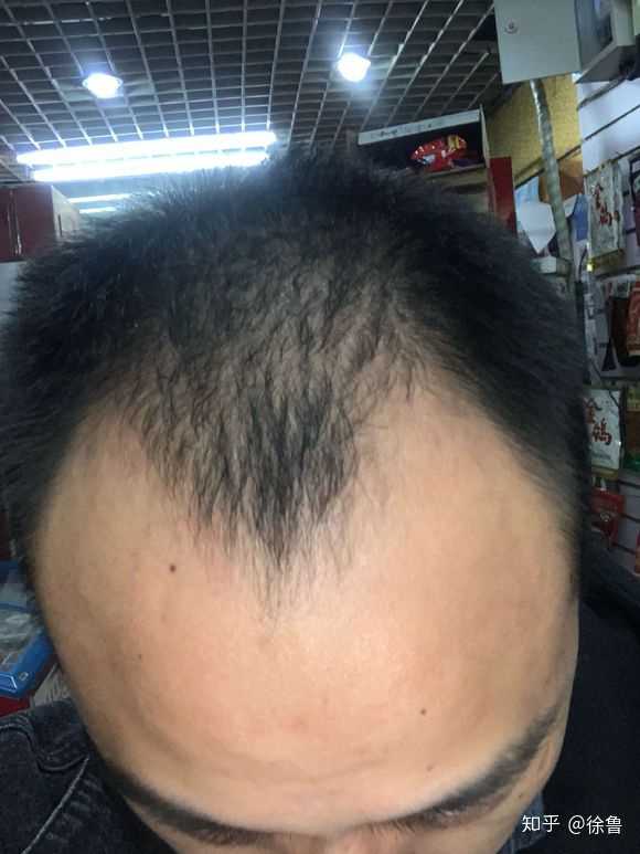 脱发真的能治好吗? - 知乎