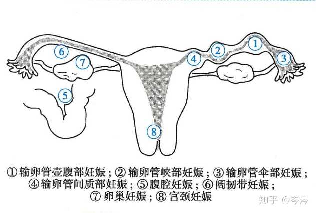 宫外孕图片示意图腹部图片