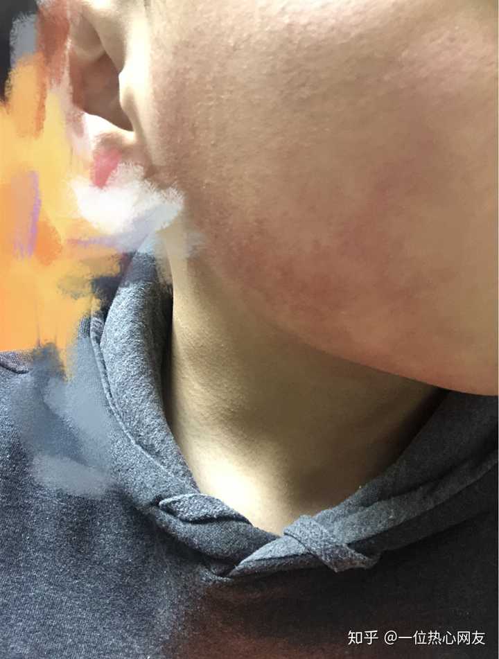 真的很想知道修复红血丝到底有什么实用的方法或者护肤品?