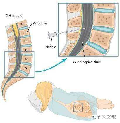 接下來,硬膜外穿刺針出場了.