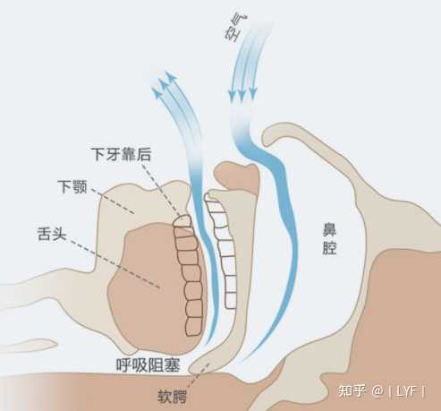 止鼾器是否真的管用 那一种类型的止鼾器管用呢 知乎